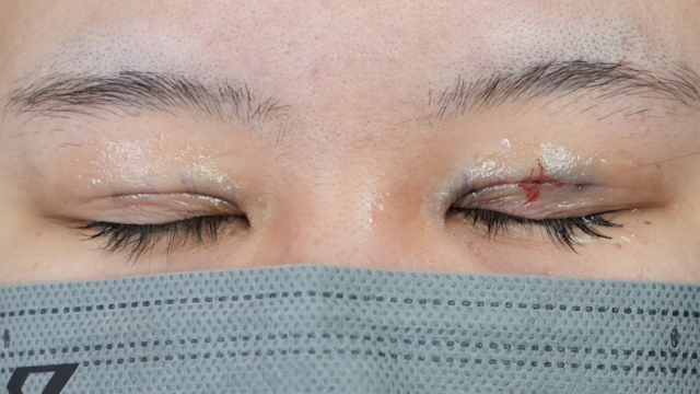 手术前的状态 其一