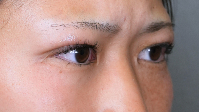 Postoperative Condition Part 1