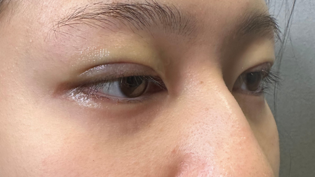 手术前的状态 其一