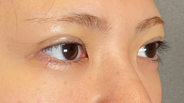 手术前的状态 其一