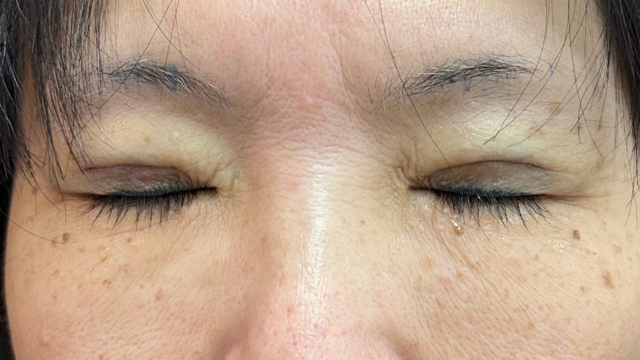 手術前の状態 その1