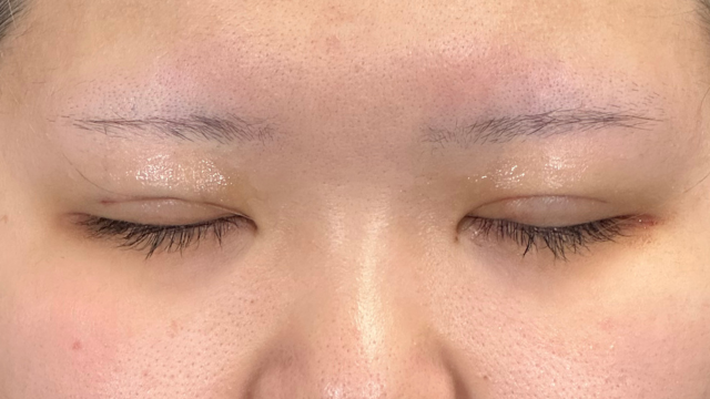 手术前的状态 其一