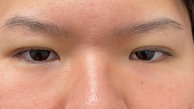 手術前の状態 その1