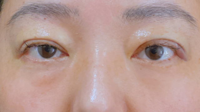 手術前の状態 その1