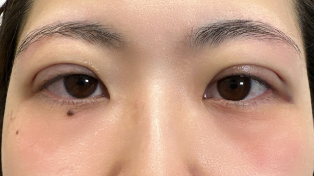 手术前的状态 其一