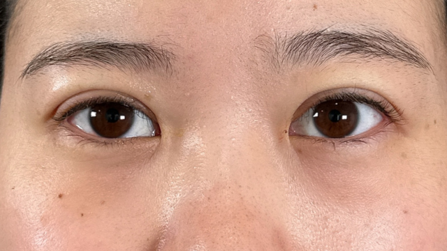 Postoperative Condition Part 1