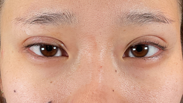 手术前的状态 其一