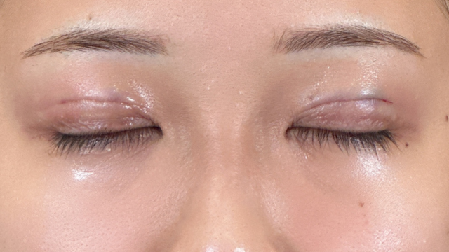 手術前の状態 その1