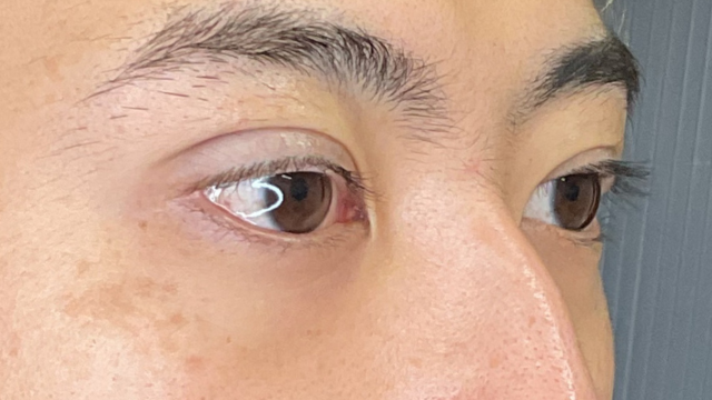 手术前的状态 其一