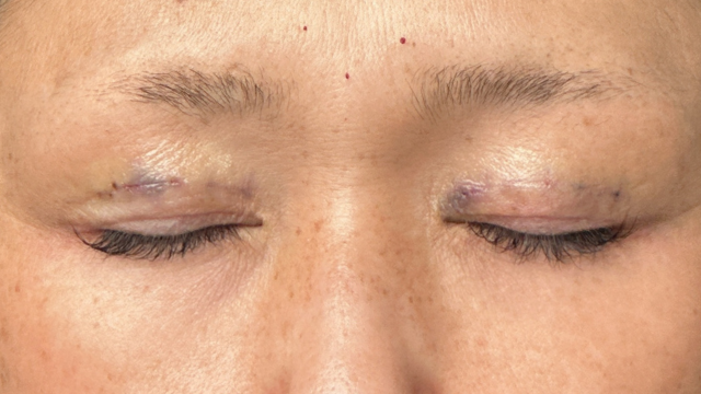 Postoperative Condition Part 1