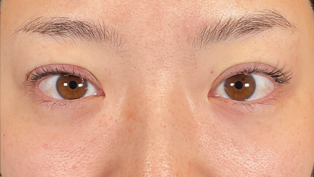 手术前的状态 其一