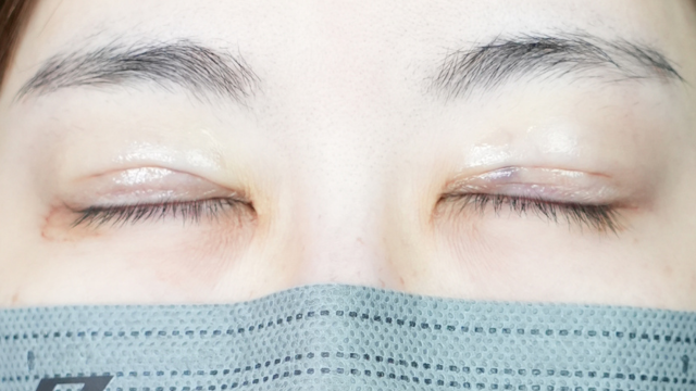 手术前的状态 其一