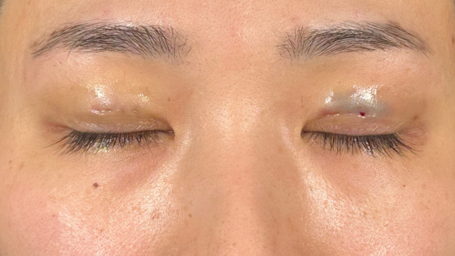 手術前の状態 その1