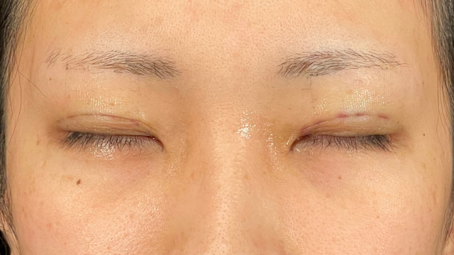 手術前の状態 その1