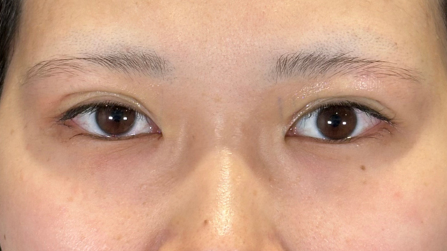 手術前の状態 その1