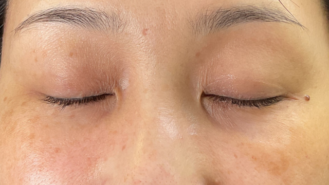 手术前的状态 其一