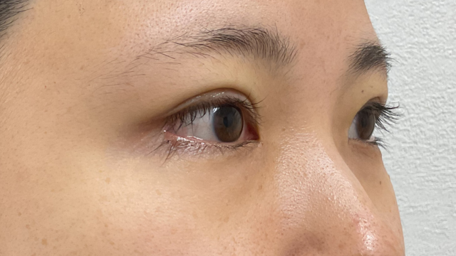 手术前的状态 其一