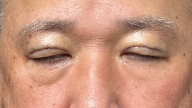 手术前的状态 其一