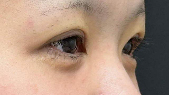 手術前の状態 その1