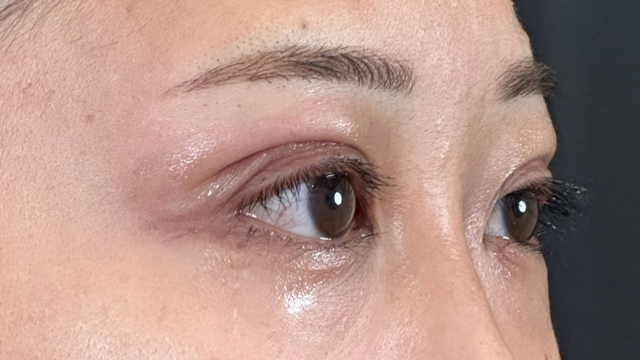 手術前の状態 その1