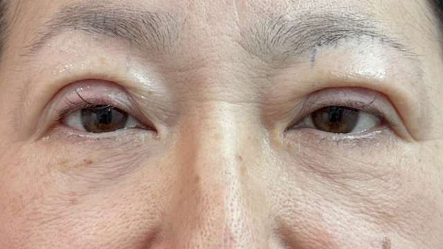 手术前的状态 其一