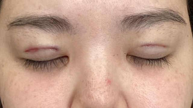 手术前的状态 其一