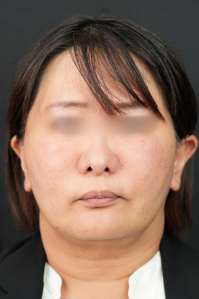 手术前的状态 其一