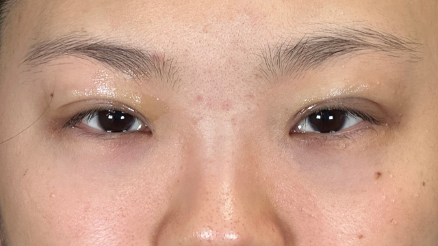 手術前の状態 その1