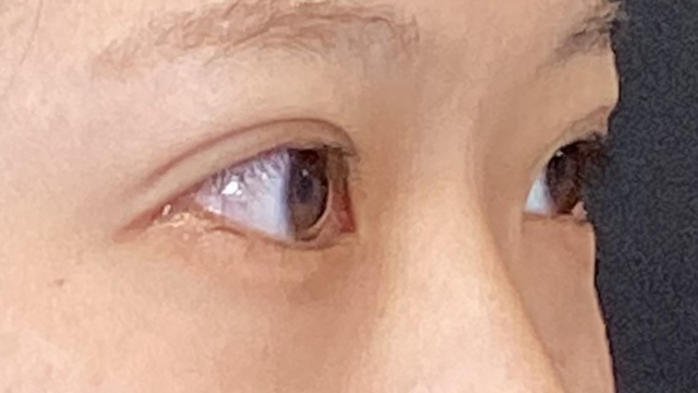 手术前的状态 其一