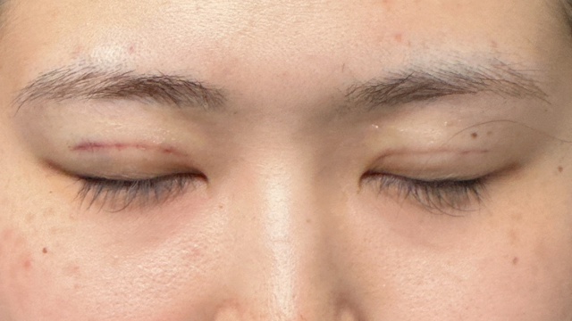 手术前的状态 其一