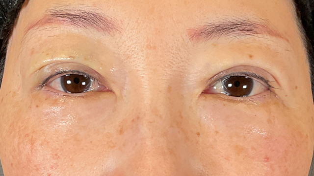 手術前の状態 その1