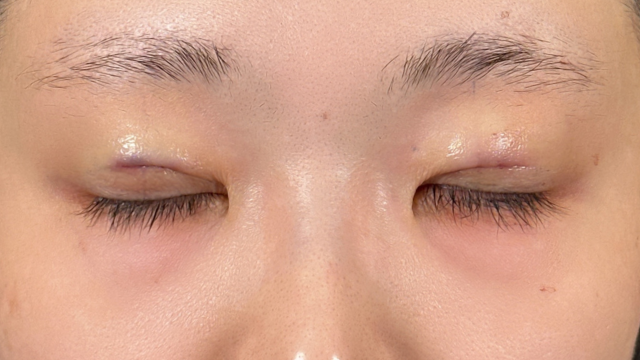 手术前的状态 其一