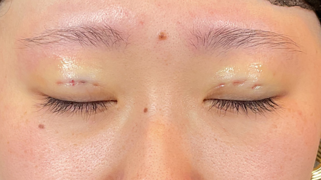 Postoperative Condition Part 1