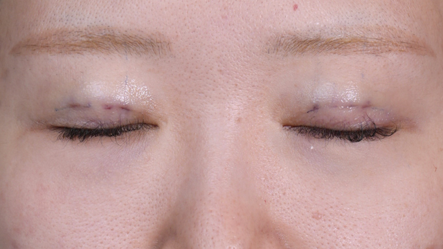 手术前的状态 其一