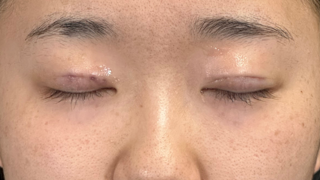 Postoperative Condition Part 1