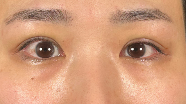 手術前の状態 その1