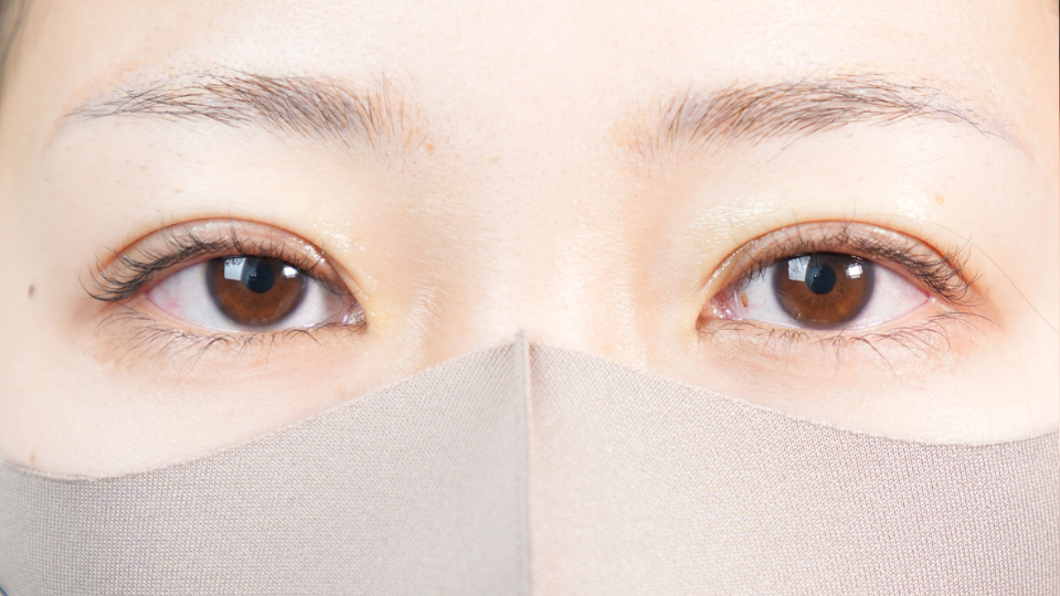 手術前の状態 その1