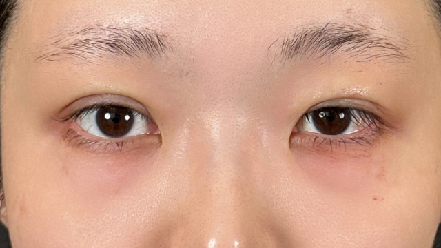 手术前的状态 其一