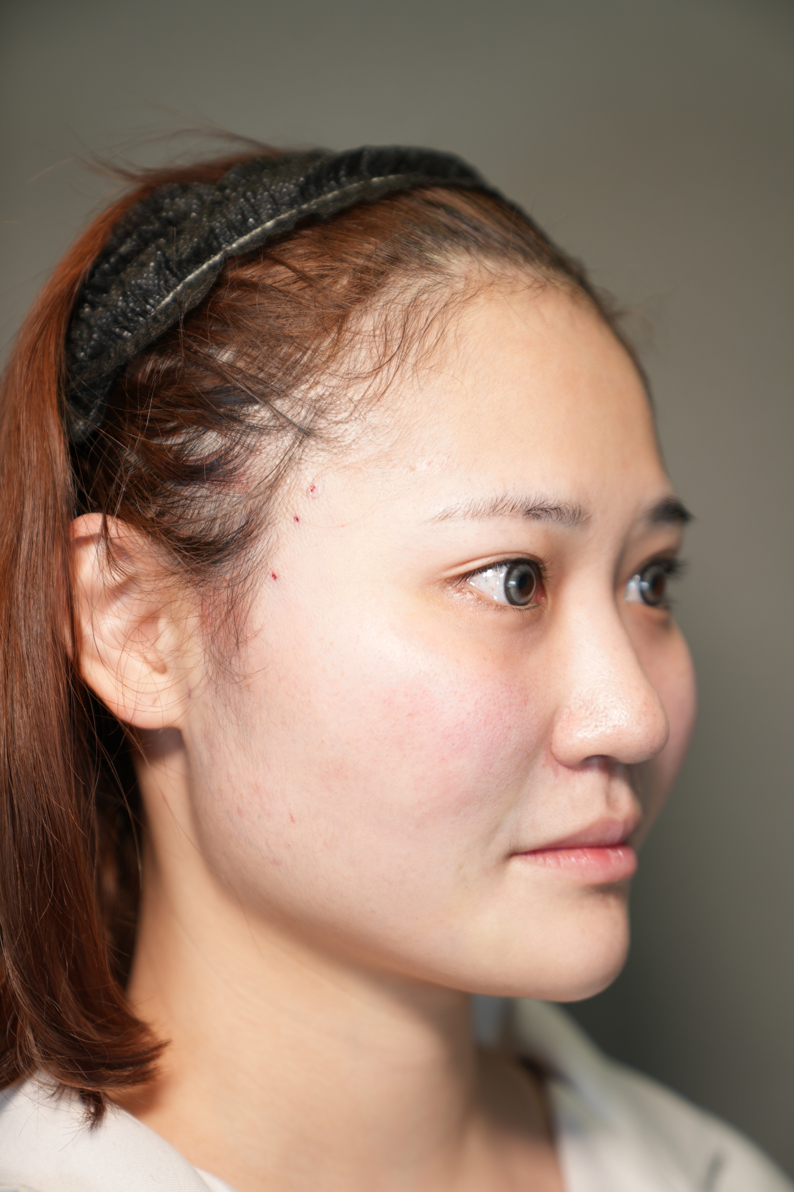 手术前的状态 其一