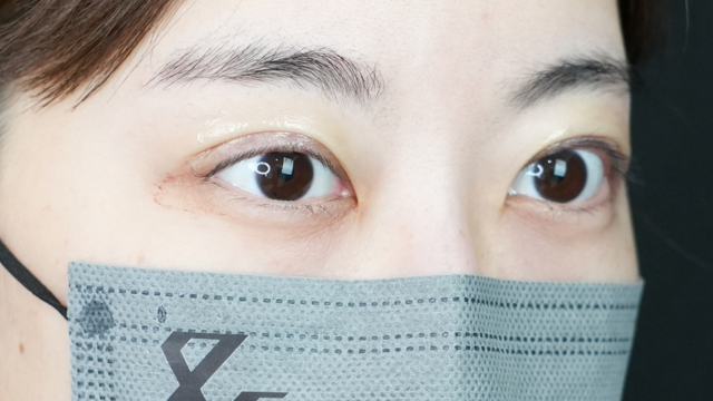 手术前的状态 其一