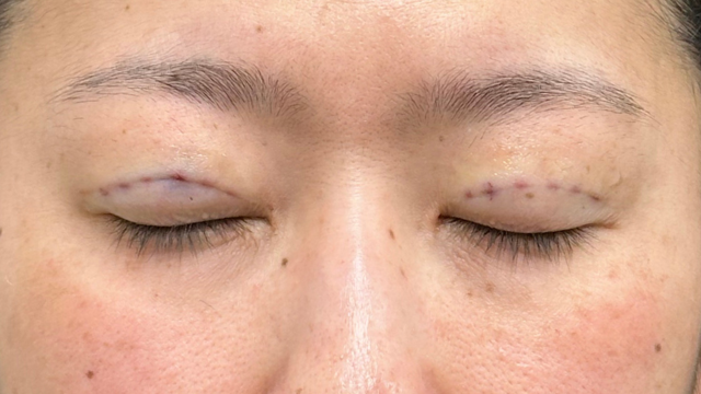 手术前的状态 其一