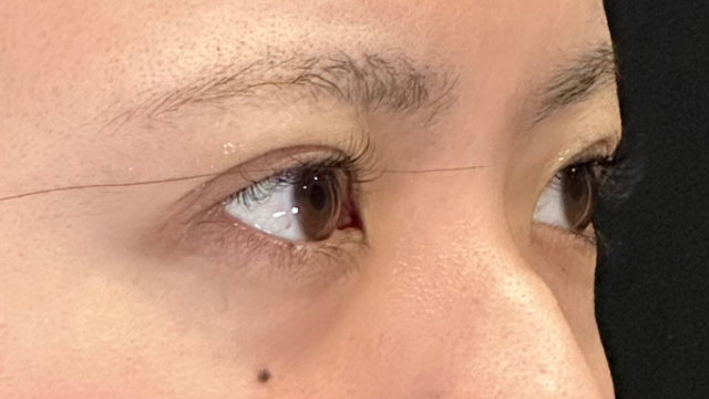 手術前の状態 その1