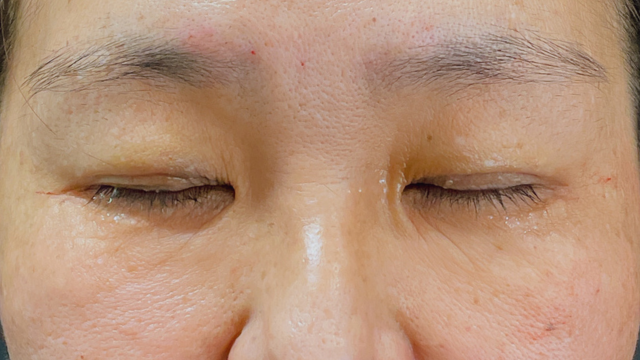 Postoperative Condition Part 1