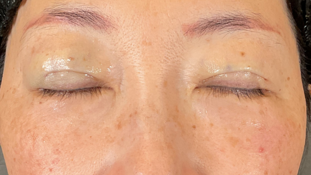 手術前の状態 その1