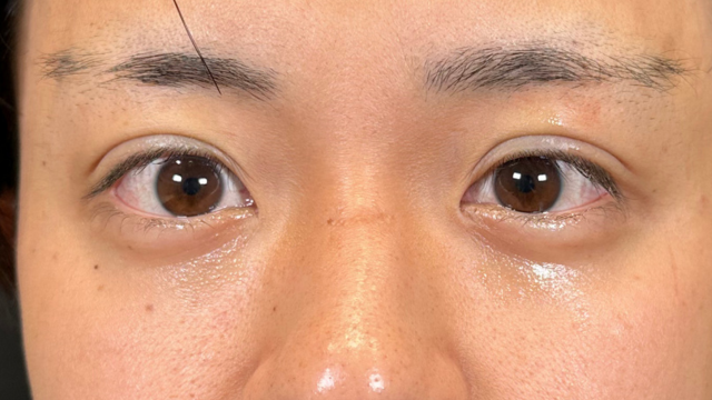 手术前的状态 其一