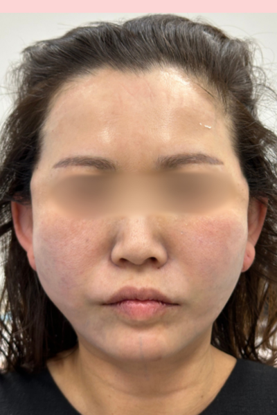 手术前的状态 其一