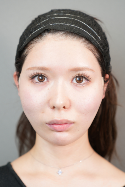 手術前の状態 その1