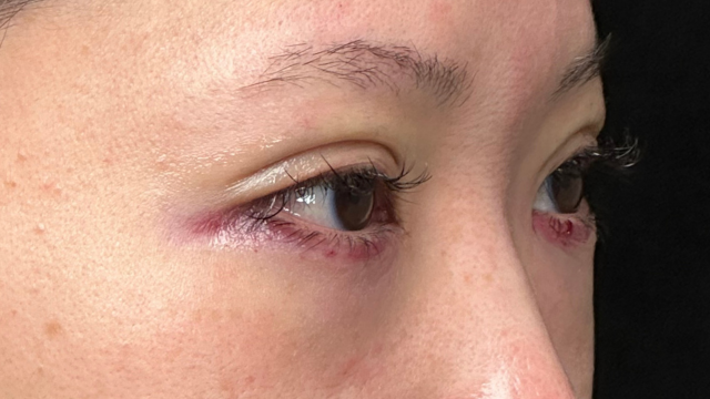 Postoperative Condition Part 1