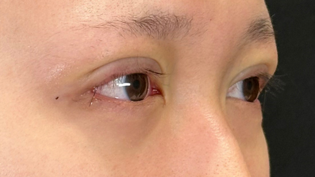 手术前的状态 其一