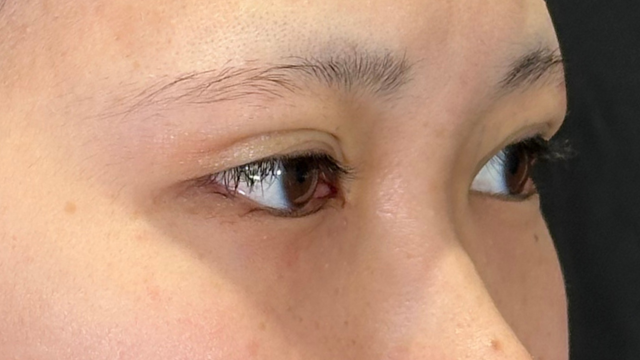 手術前の状態 その1